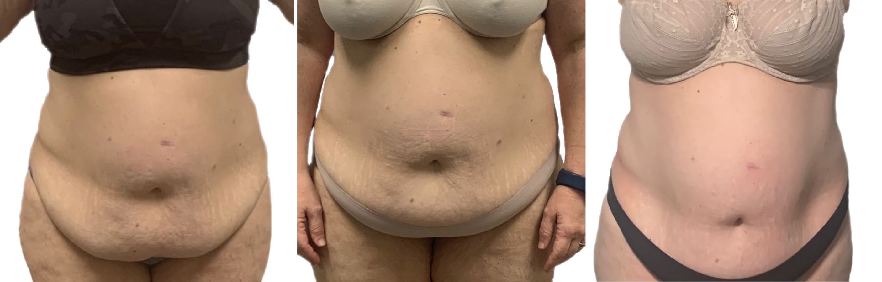 Dramatic fat and loose skin reduction